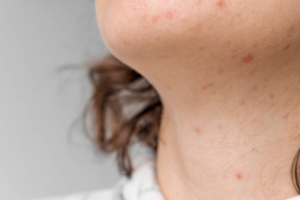 Santé : la rougeole s’intensifie en Europe